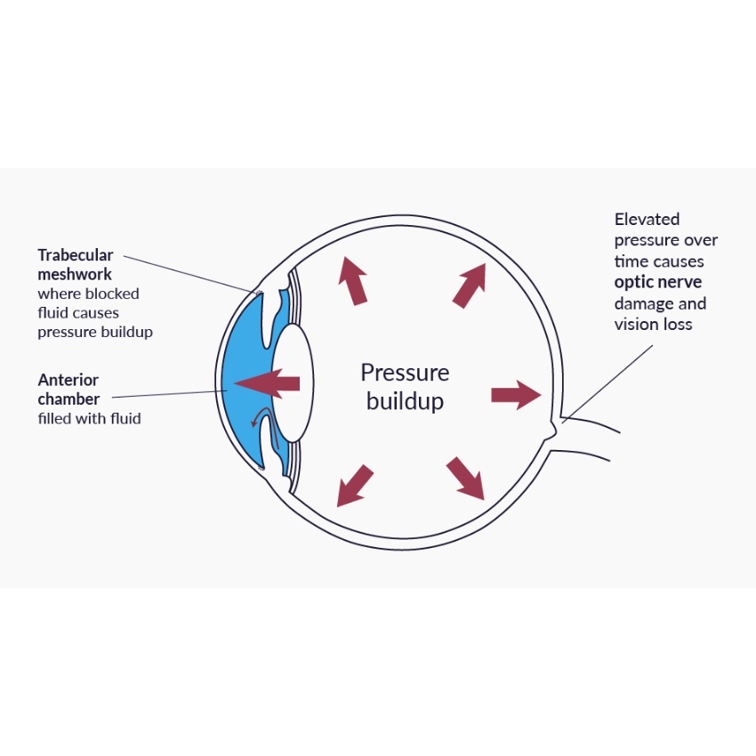 Cross-section of an eye showing pressure buildup causing optic nerve damage. Text: Trabecular meshwork where blocked fluid causes pressure buildup; Anterior chamber filled with fluid; Elevated pressure over time causes optic nerve damage and vision loss.